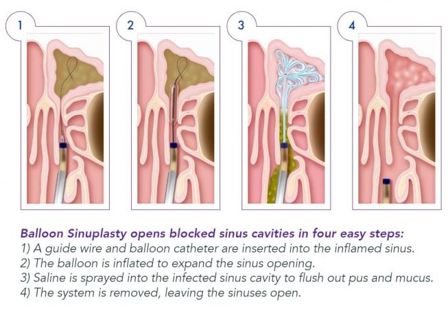 Balloon Sinuplasty Adobe ENT Allergy